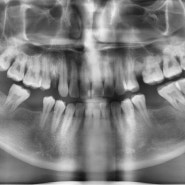 [군산 치과] 예미담 치과 임플란트 치료 이야기