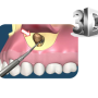 안산 치근단절제술 ) 치아뿌리염증, 서울윈치과 미세 치근단수술