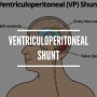 V-P shunt (ventriculoperitoneal shunt)