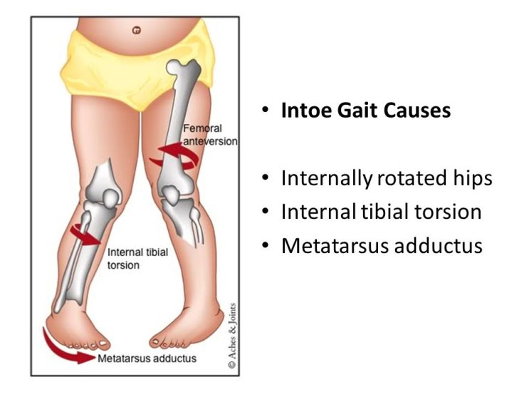 안장걸음(toe in walking)과 중족골 내전증(metatarsus adductus) : 네이버 블로그