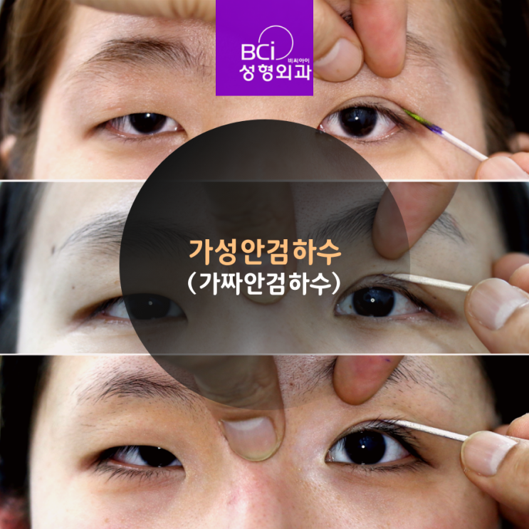 가성안검하수는 쌍꺼풀수술만 하면 됩니다 : 네이버 블로그