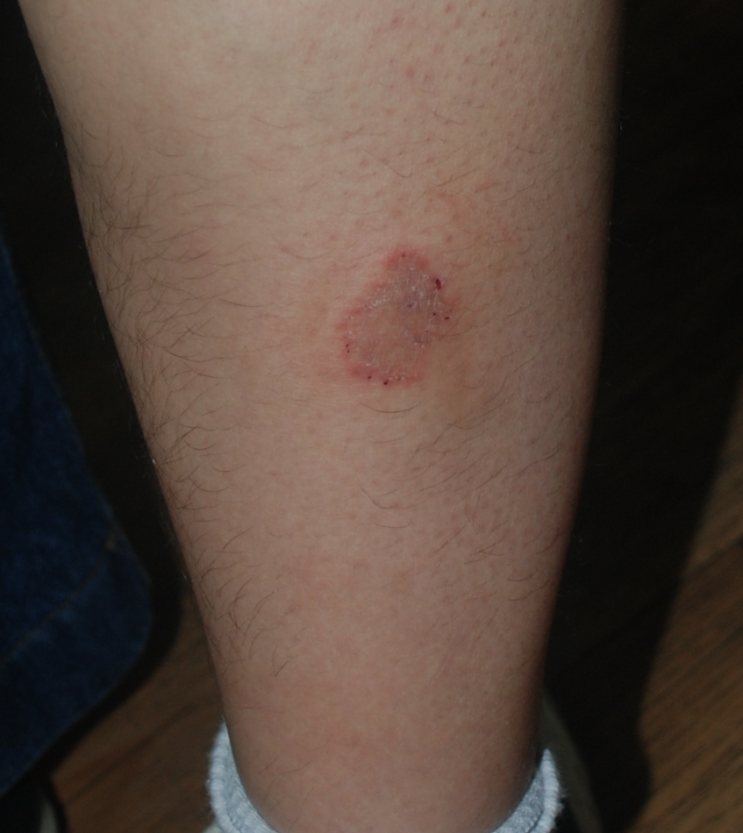 몸백선증(tinea corporis) : 네이버 블로그
