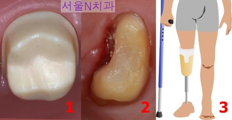 발치와 임플란트, 그리고 치근 절제술 Root Amputation을 통한 자연 치아 살리기 사이, 선택의 기로에서... 치과 ...