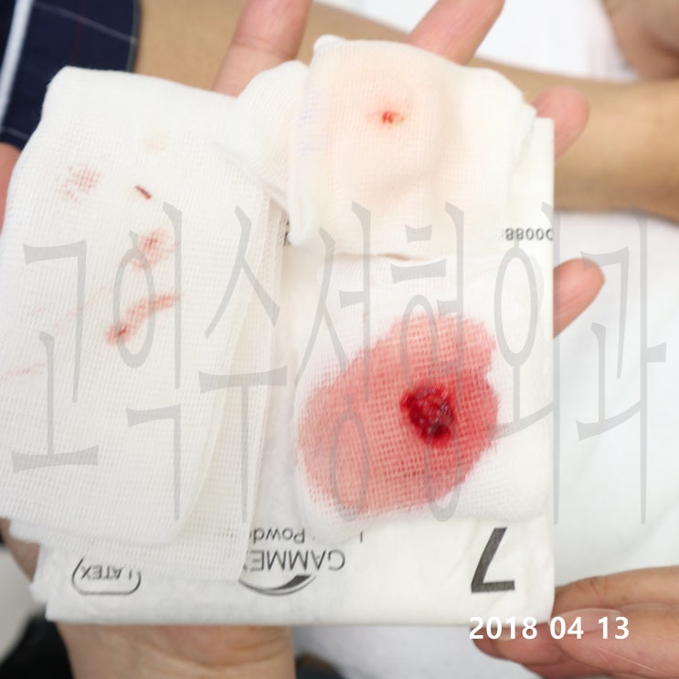 볼필러 부작용 : 네이버 블로그