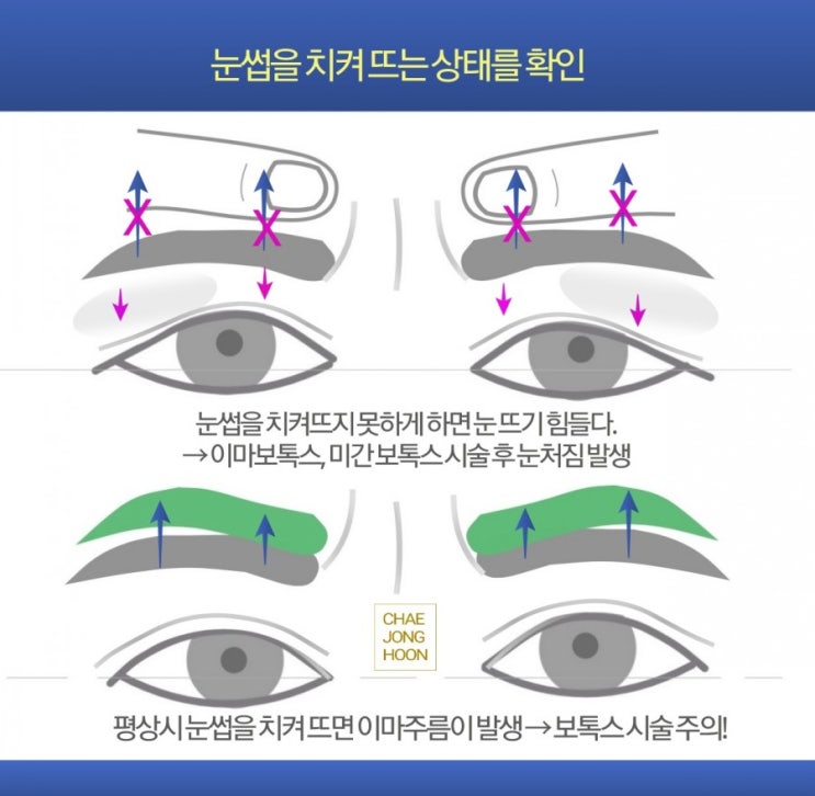 미간보톡스: 미간주름에 대한 보톡스시술 후 부작용 : 네이버 블로그