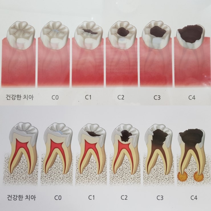 단계별로 알아보는 충치증상 및 치료방법 : 네이버 블로그 단계별로 알아보는 충치증상 및 치료방법 : 네이버 블로그