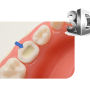 정왕동 치과 신경을 보호하는 충치치료 : 서울윈치과 MTA indirect pulp capping (간접치수복조법)