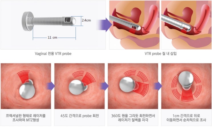 통증 없는 질 타이트닝, 질 수축! 질 레이저 시술. : 네이버 블로그