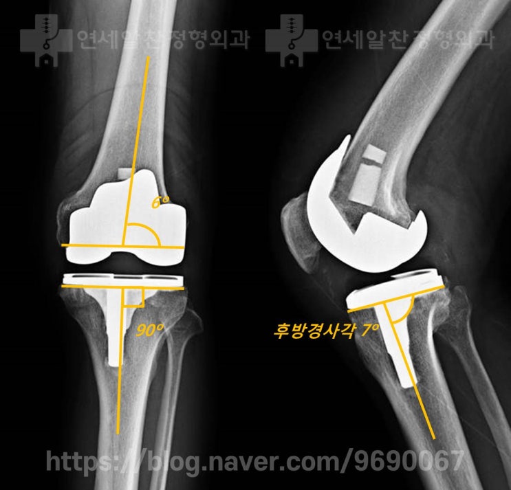 무릎 퇴행성 관절염에서 수술적 치료의 선택 (인공관절 vs 카티스템 vs 근위교정절골술)