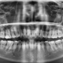 턱관절질환(TMD; Temporomandibular joint dysfunction)