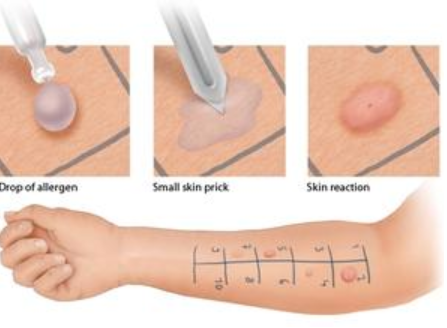알레르기 진단방법(1) : 피부단자검사(skin prick test) : 네이버 블로그
