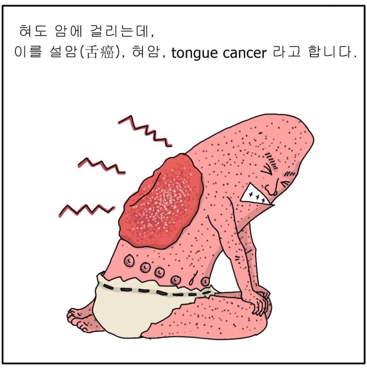 알기쉬운 구강암 - 설암 (혀암, tongue cancer, 舌癌) : 네이버 블로그
