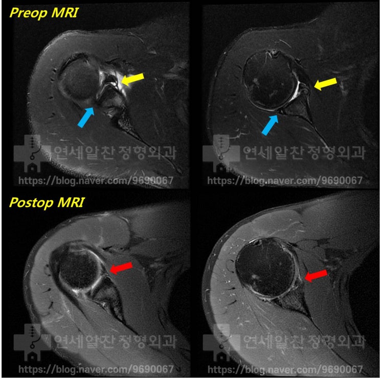 반카르트 봉합술 후 결과 - MRI 상 해부학적 복원
