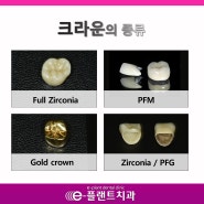 부산 치과 : e-플랜트치과 신경치료 후 보철의 종류
