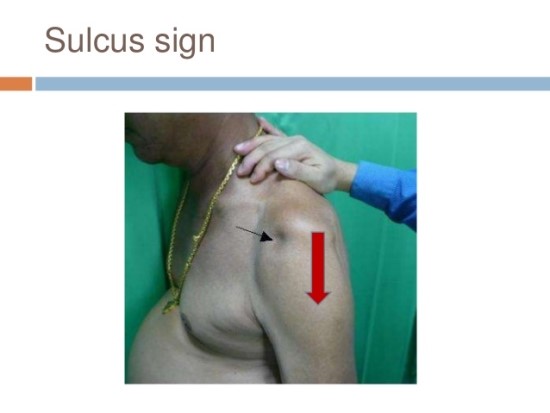 고랑징후(Sulcus sign) 어깨하방 불안정성 검사 : 네이버 블로그