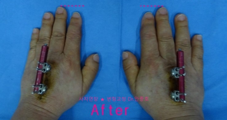 양손 가운데 손가락(중지) 단지증 동시 연장수술 전후기 사진 : 네이버 블로그