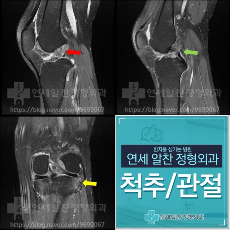 슬관절 통증의 진단에서 history taking, 이학적 검사의 중요성