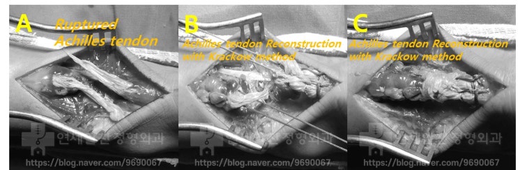 아킬레스건 파열의 진단 및 치료