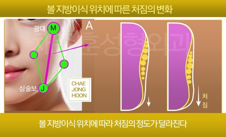 얼굴 지방이식 후 볼처짐(부작용?): 원인과 개선방법 : 네이버 블로그