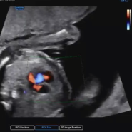 임신20주차 - 임산부 변비, 정밀초음파 보는 방법