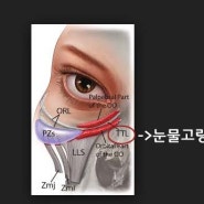 다크써클과 눈밑지방을 흉터없이 해결하는 눈밑지방재배치