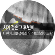 서울대입구 미소랑치과 치아 결손 후 변화