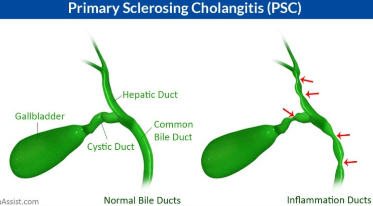 psc-primary-sclerosing-cholangitis