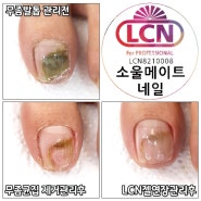 발톱무좀 LCN관리