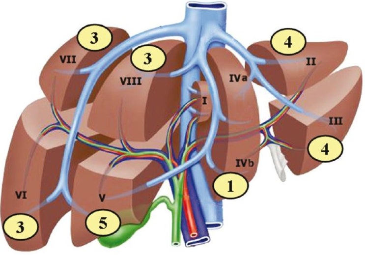 조기 간암에서 외과적 간 절제(Liver Resection)와 간이식 : 네이버 블로그