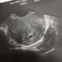 [임신4주] 아기집 확인 - 세입자님을 기다립니다.