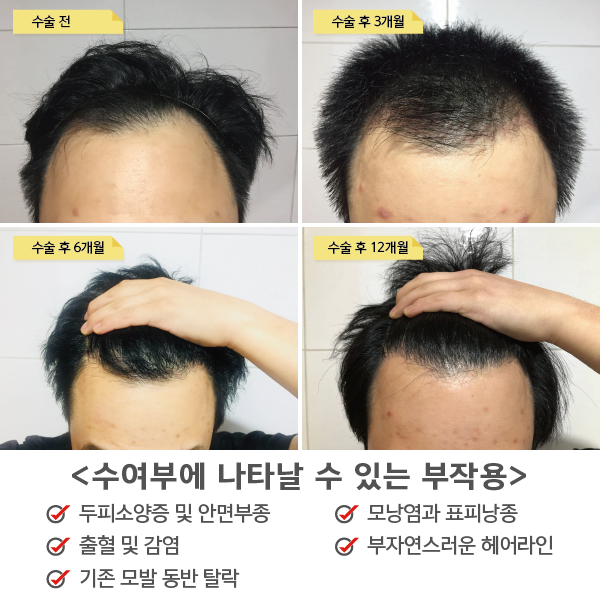 모발이식 후 수여부에 나타나는 부작용과 예방법 : 네이버 블로그