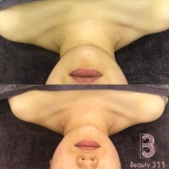 [ Body care ] 해운대 마린시티 피부관리 얼굴관리 는 뷰티 311 에서