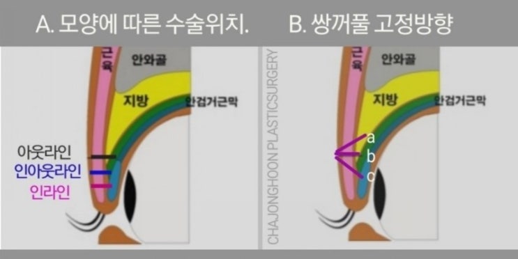 자연스러운 쌍꺼풀을 만들기 위한 절개방법: 부분절개법/흉터와 풀릴 가능성 : 네이버 블로그