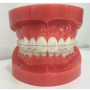 서초역치아교정 새이치과 치아교정 - 얇은철사를 사용한 치아교정치료