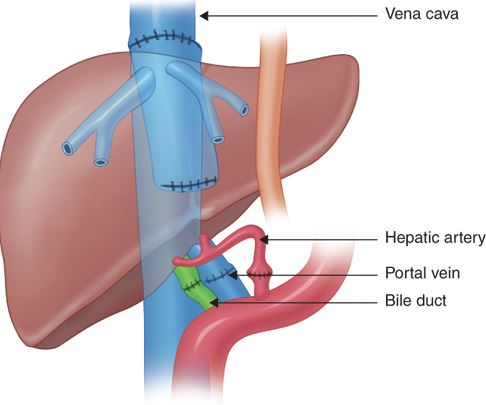 간이식 수술 시 담도 문합의 방법 (Biliary Reconstruction) : 네이버 블로그