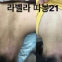 목뒤 선천성 밀크커피 반점 레이저 치료 비용, 전후 사진