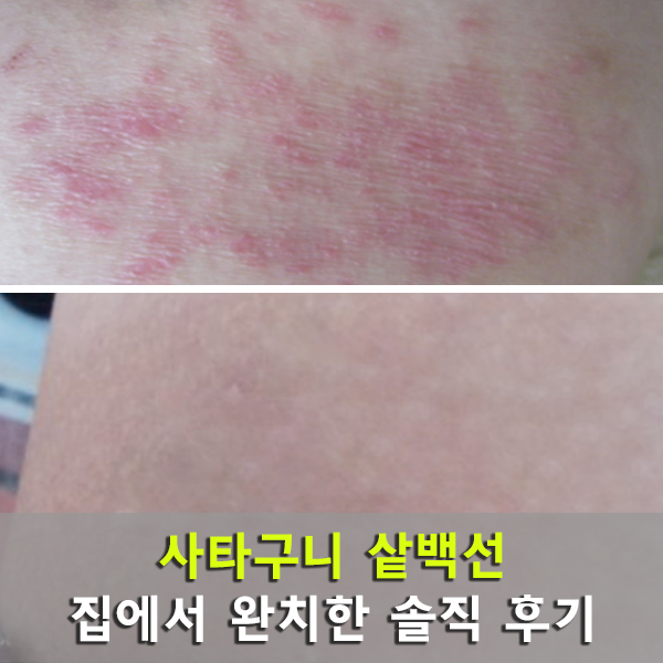 사타구니 가려움, 샅백선 혼자서 완치했어요 : 네이버 블로그
