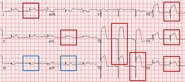 급성 관동맥증후군, STEMI vs NSTEMI : 네이버 블로그