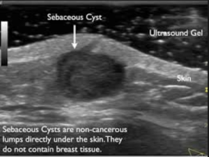 [Breast] sebaceous cyst , epidermoid cyst : 네이버 블로그