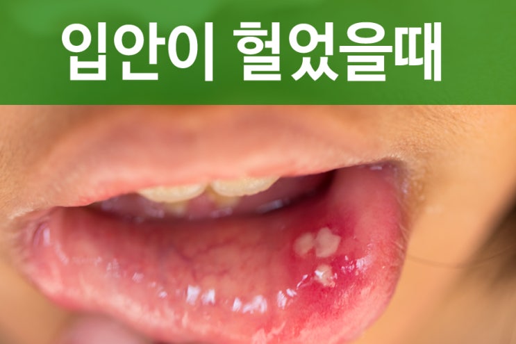 입안이 헐었을때 치료와 구내염 예방법 : 네이버 블로그