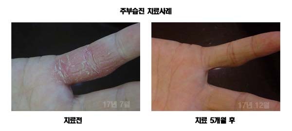 주부습진, 손 습진 - 염증 치료부터 하자!! : 네이버 블로그