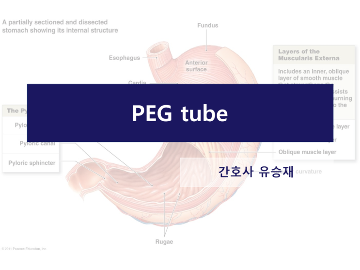 경피적 내시경 위조루술 (PEG tube) : 네이버 블로그