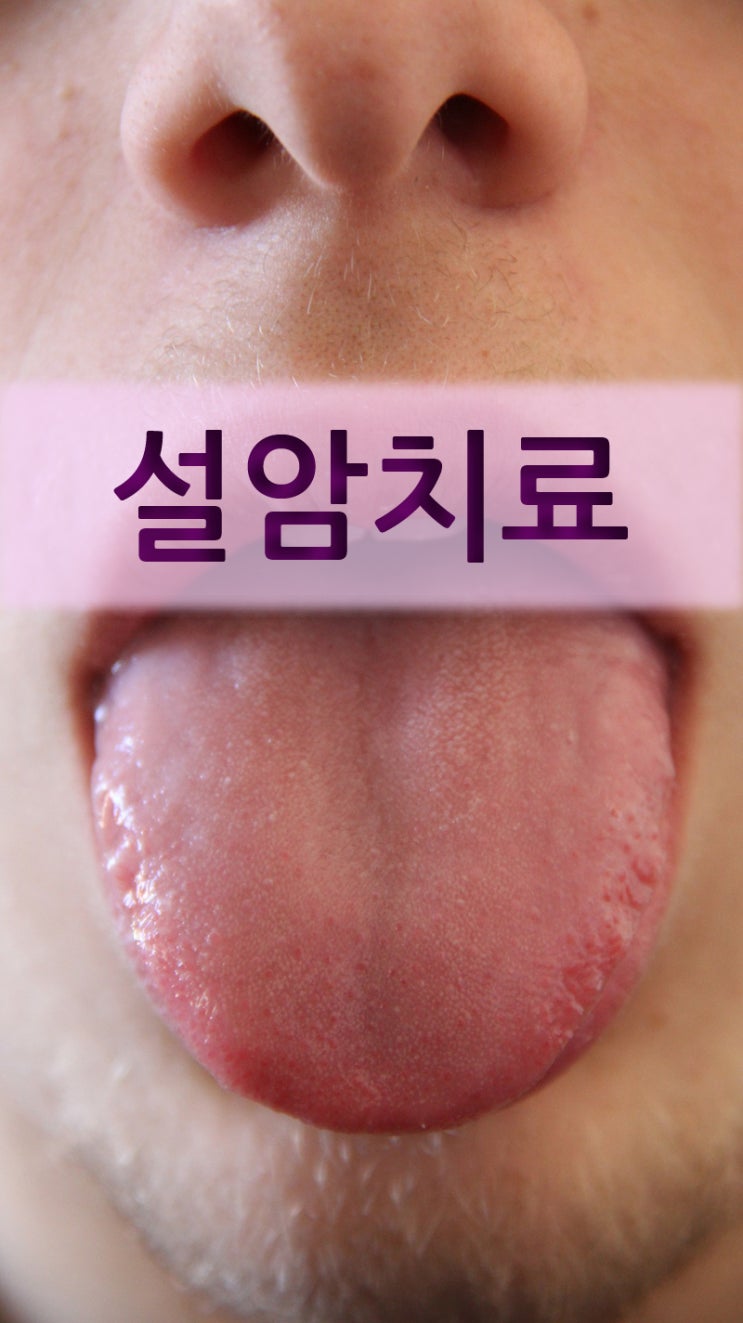 설암치료, 복합적으로 : 네이버 블로그