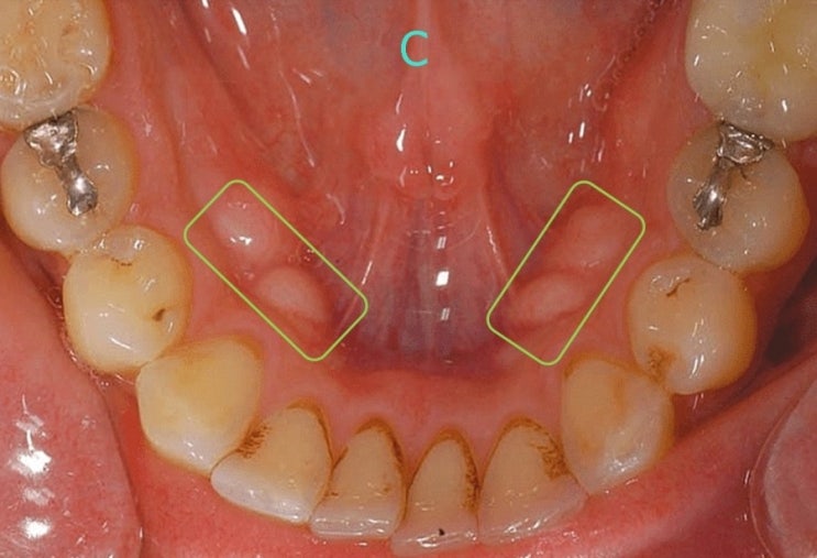 잇몸,입안,혀밑에 딱딱한 혹이 있어요! 구강암인가요? - 외골증,골융기(토러스) : 네이버 블로그