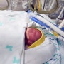 [이른둥이 일기] 29주 6일 봄이 태어나다. 임신중독으로 인한 이른둥이 출산