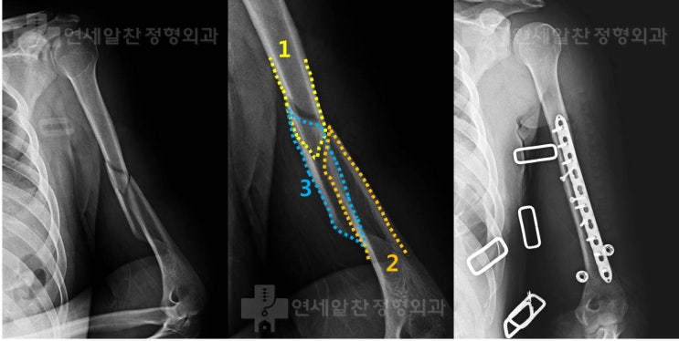 상완골 간부 복잡 골절에서 관혈적 정복술 및 금속 내고정술의 결과