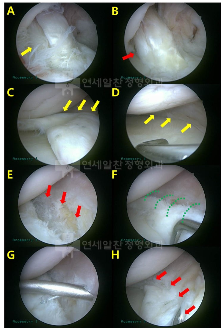 내측 반월상 연골의 양동손잡이형 파열에서 in & out 봉합법 및 all - inside 봉합법을 이용한 봉합술의 결과