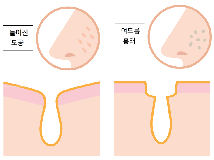 모공줄이는 방법 #3 (늘어진 모공, 모공성 흉터, 여드름 흉터, 프락셀) : 네이버 블로그