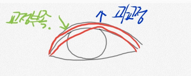 쌍꺼풀재수술/눈매교정 부족과 과교정/ 눈매교정 부작용 : 네이버 블로그