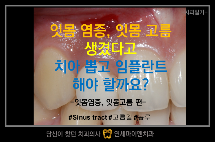 잇몸에 염증 있다고, 잇몸에 고름 잡혔다고, 치아뿌리끝에 염증 있다고 뽑아야 된대요. : 네이버 블로그